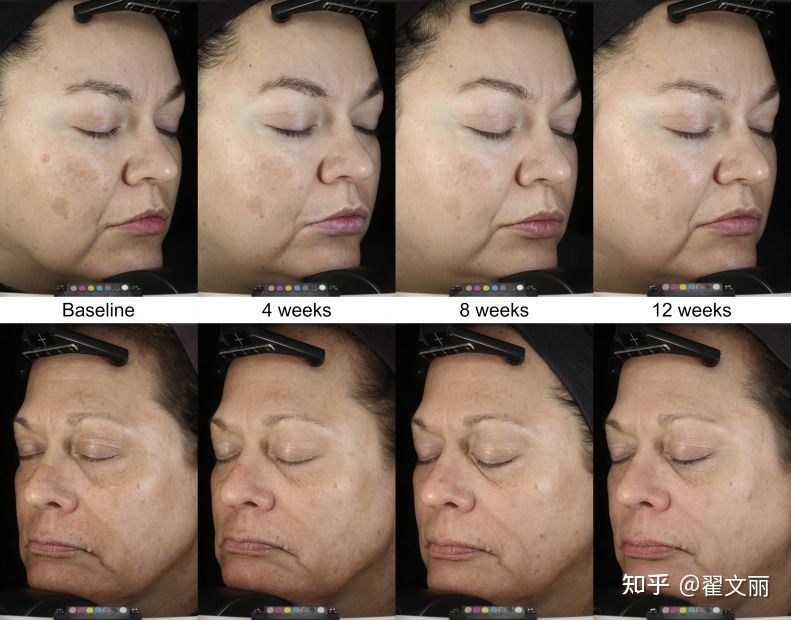 中药祛斑美白养颜精华套装第3代,美白淡斑祛斑精华真实测评