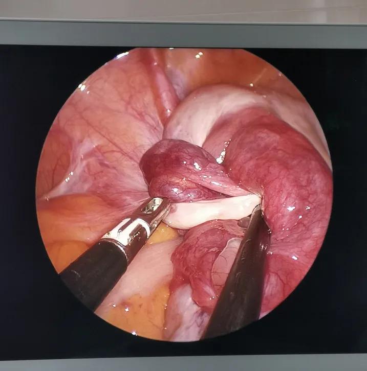 卵巢囊肿微创手术后患者状况,腹腔镜下卵巢囊肿切除术步骤