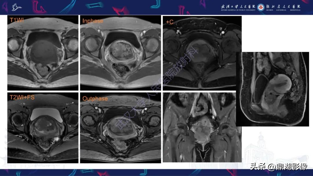 阴道里长肉瘤是啥症状,阴道肉瘤症状