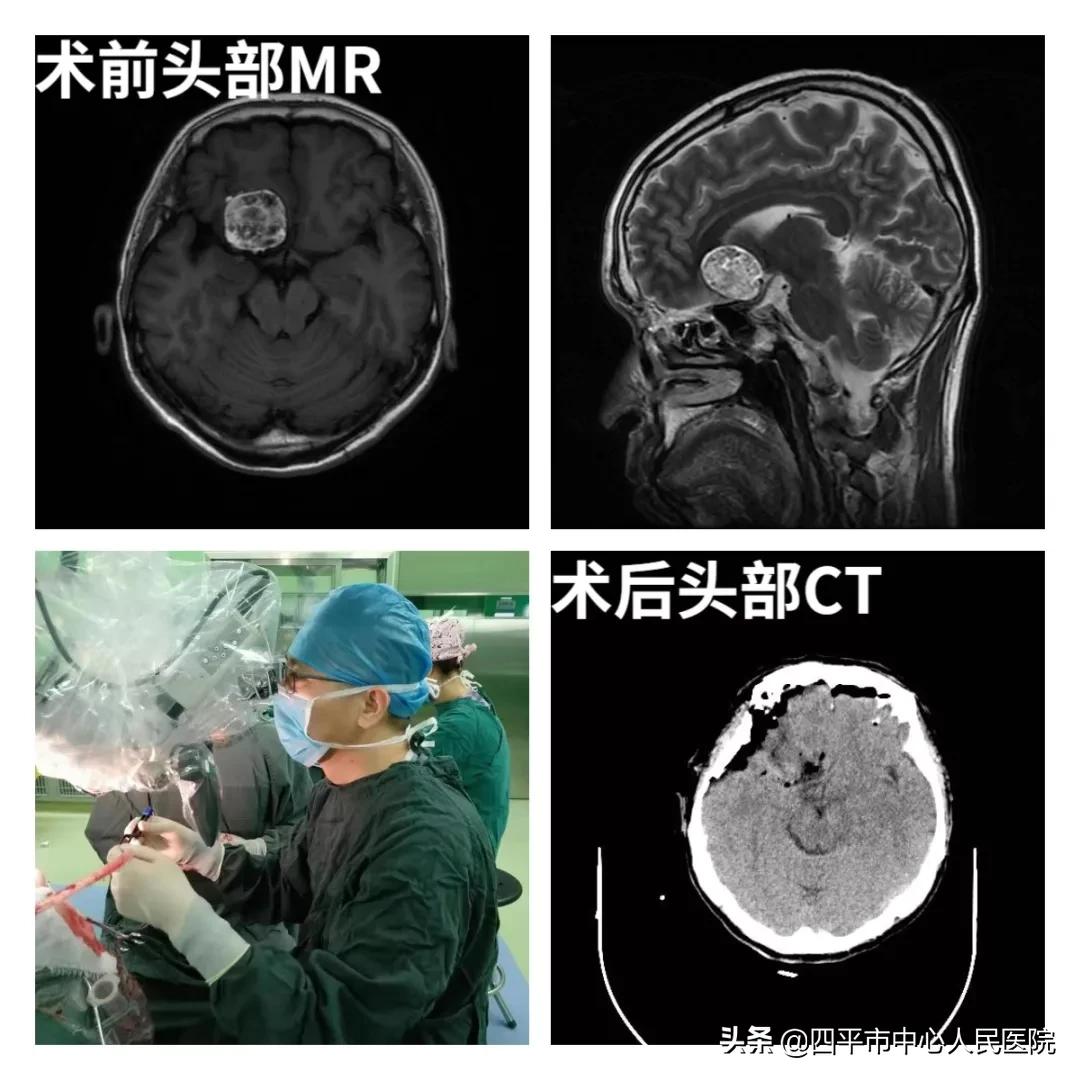 脑肿瘤治疗最新技术,治疗脑肿瘤的靶向药有哪些