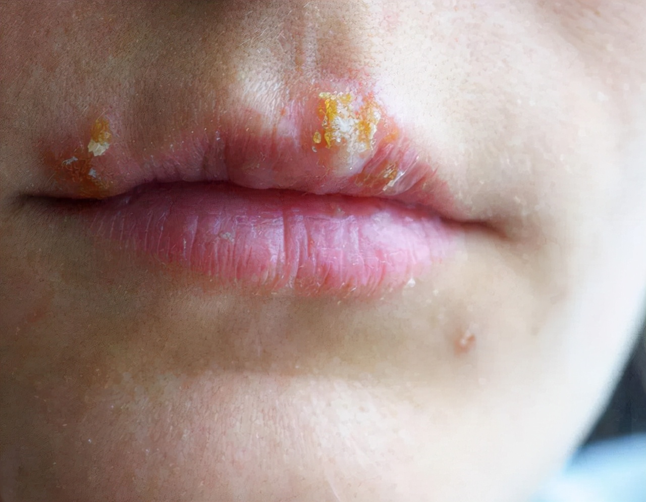 嘴巴边缘长水泡是上火了吗,嘴唇上火长水泡最简单的解决方法