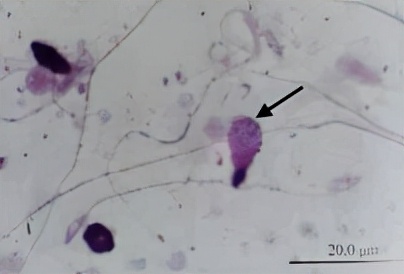 uu感染是什么意思,uu感染严重吗