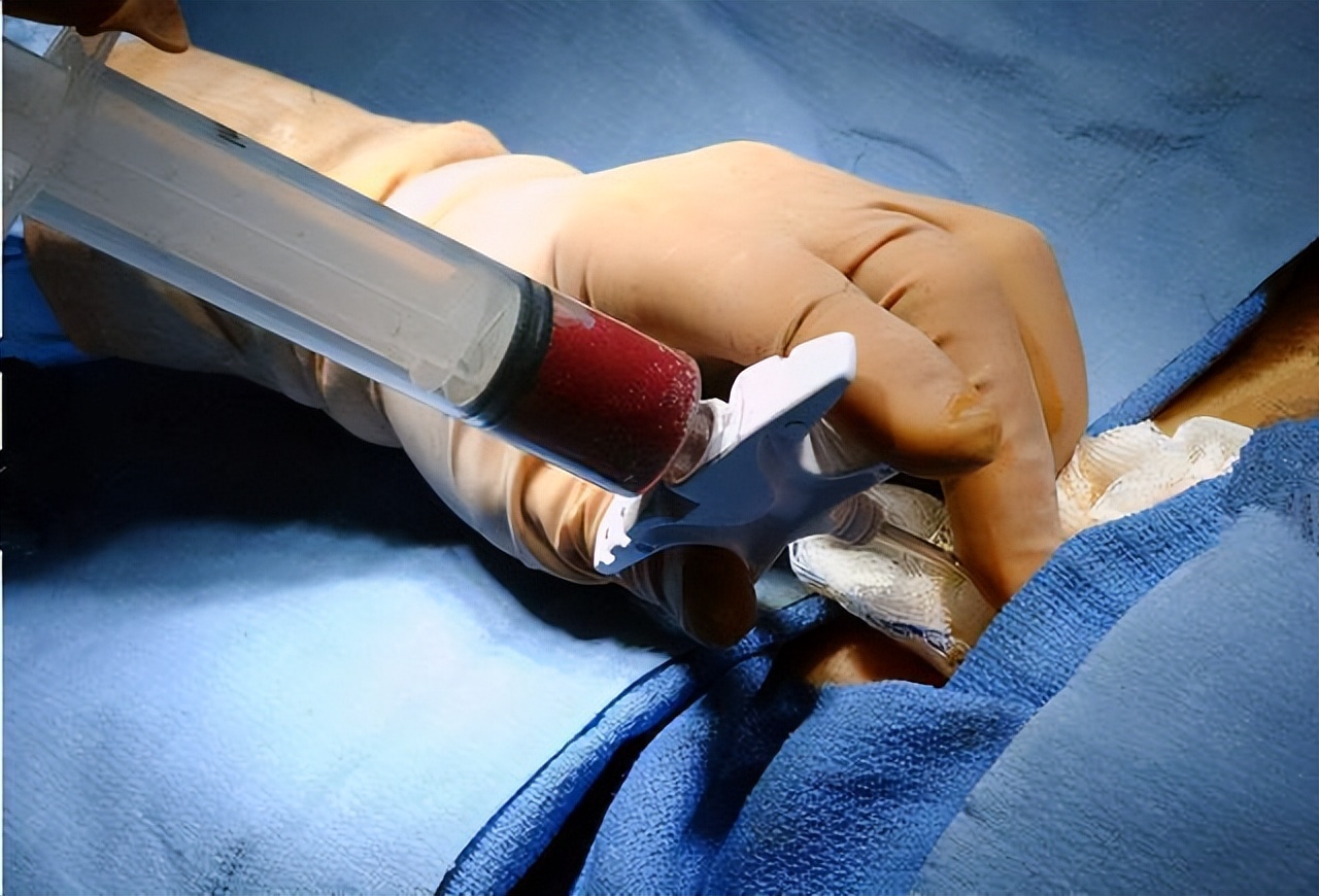 夫妻借了20万做试管婴儿,黑龙江夫妇借22万做试管