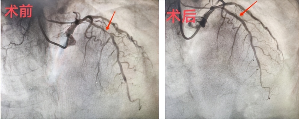 冠脉支架遇到“顽石”挡路，近段狭窄最重处约90%，这该怎么办？