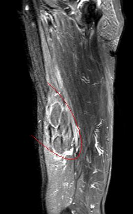 身体出现包块比较硬有疼痛感,身体上长了个包