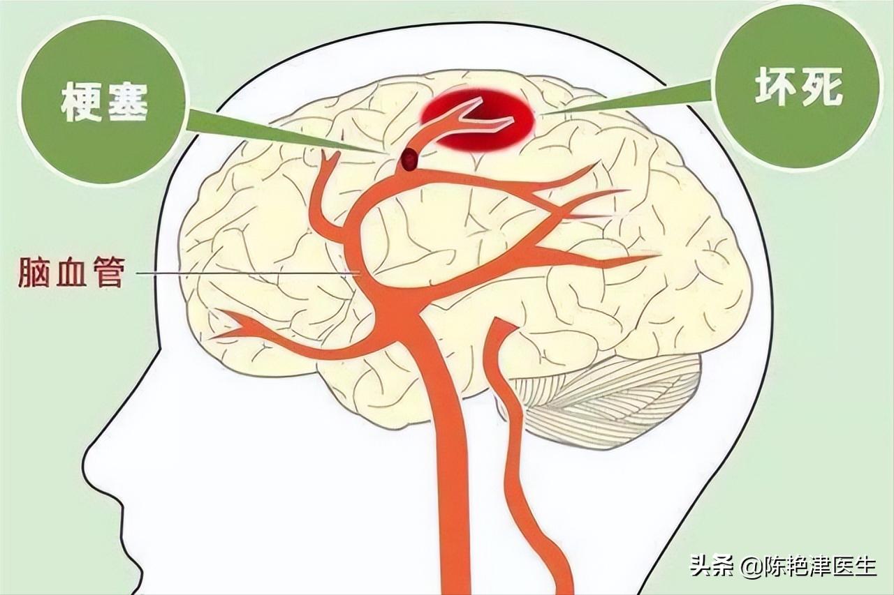 突发脑梗的五个信号,脑血栓脑袋滋滋的声音