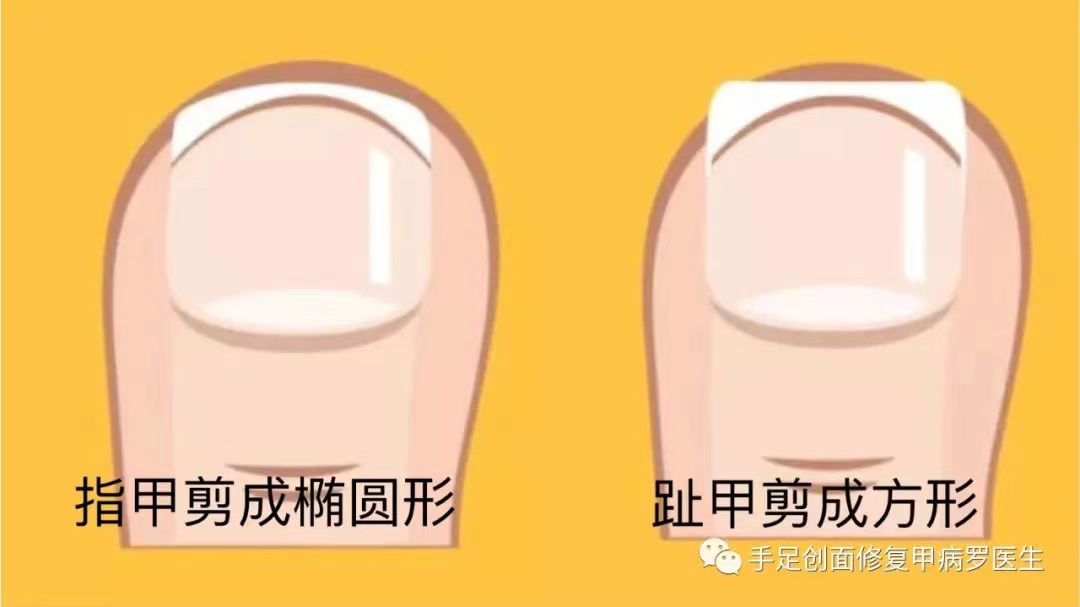 甲沟炎十年,有史以来最严重的甲沟炎