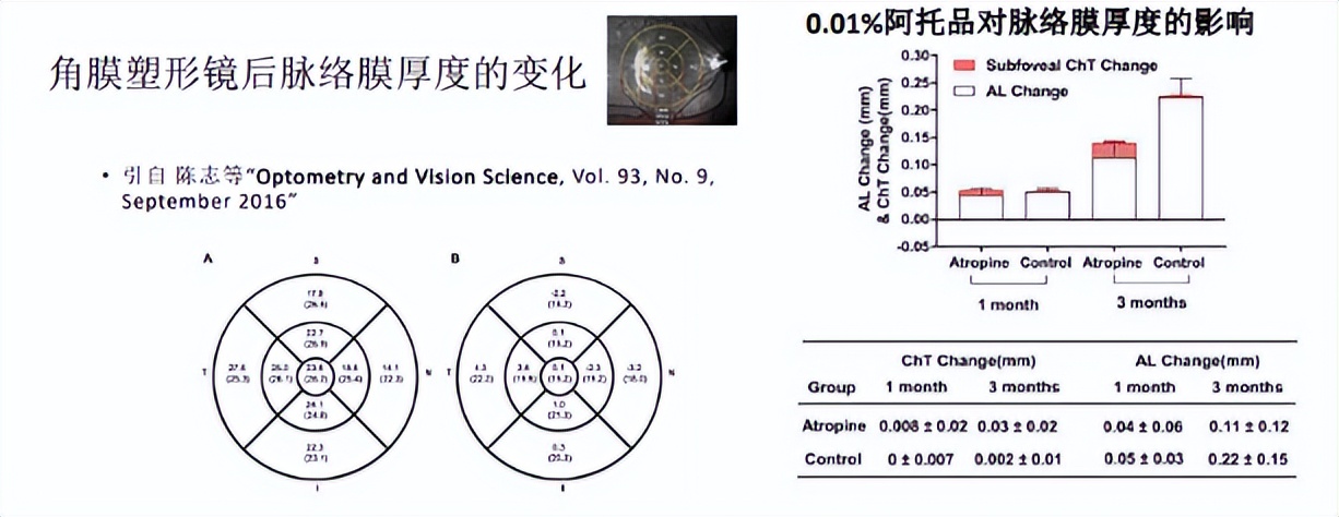 王凯角膜塑形镜原理,王凯医生塑形镜