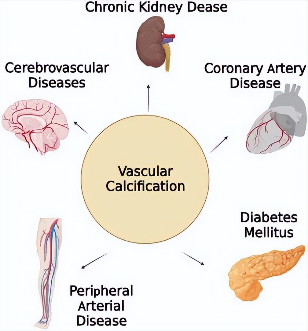 血管钙化的机制是什么,血管钙化如何治疗吃什么中成药