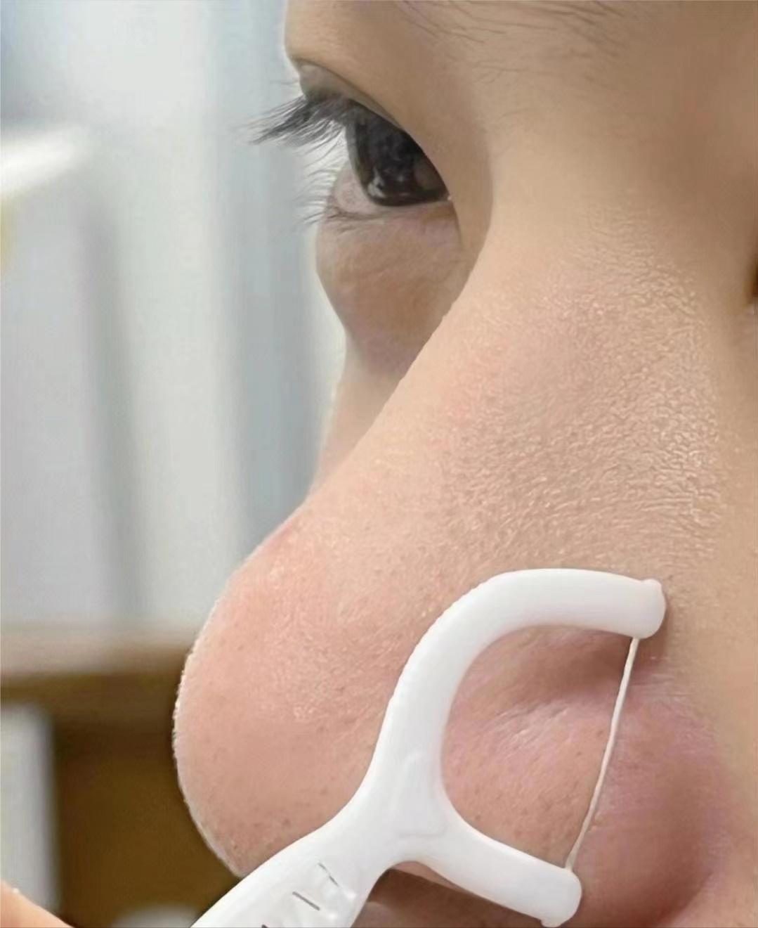 每天就花几块钱就能淡化色斑,螨虫痘能彻底消除吗