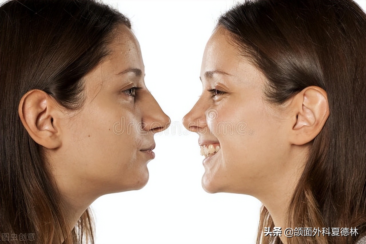 怎么做鼻子永久不变形,怎样把鼻子变好看不做手术