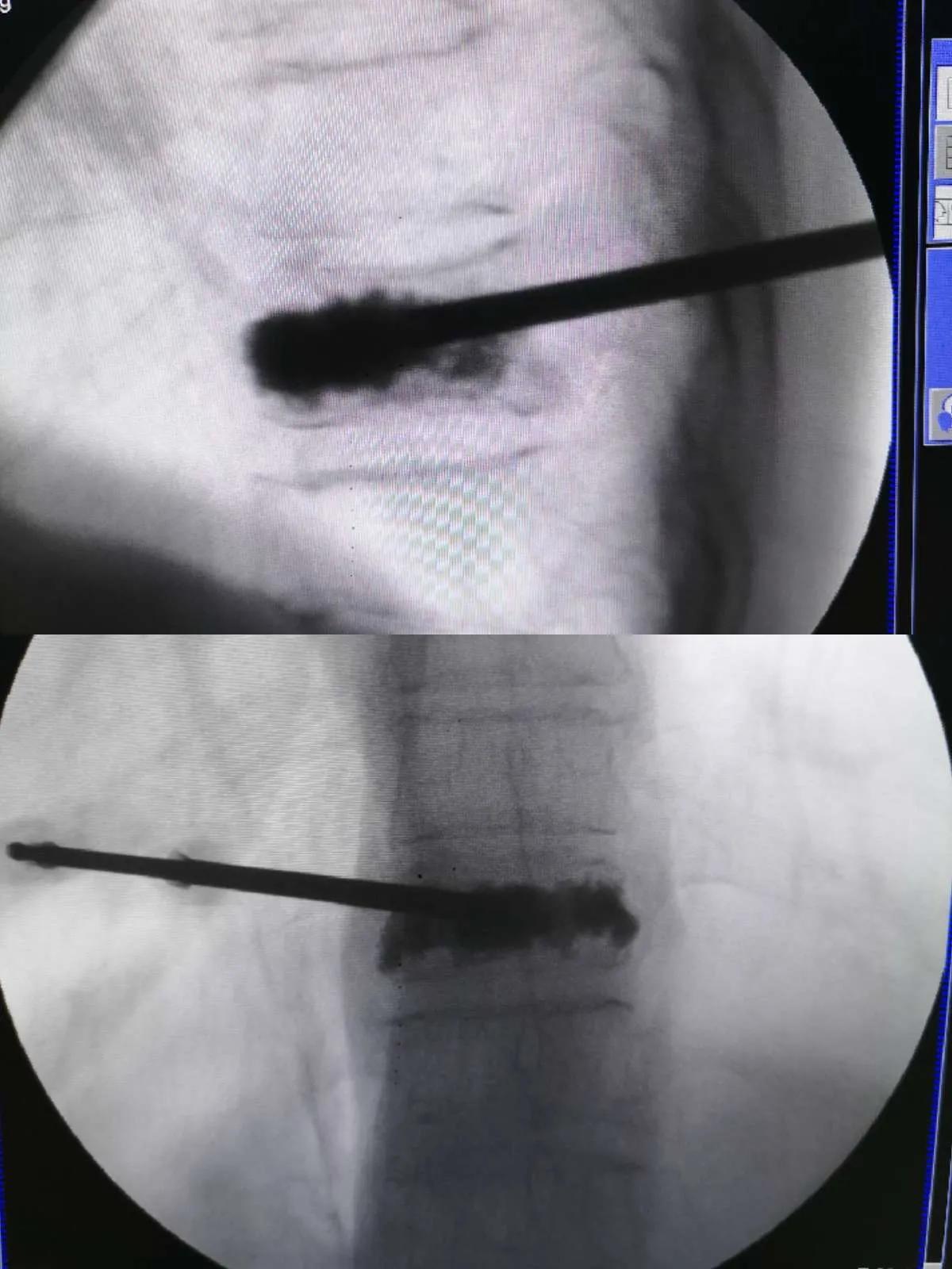 大腿骨折能不能用骨水泥粘住,神奇骨水泥