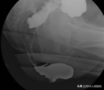 粑粑拉不出来是为什么,粑粑拉不出来按哪里