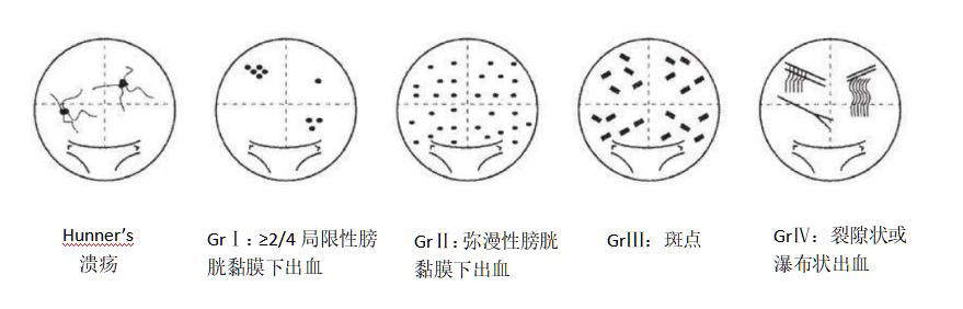 膀胱疼痛综合征的病例,膀胱疼痛综合征主要表现