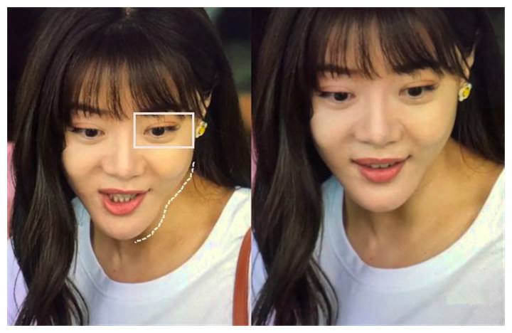 哪些明星整容后遗症越来越严重,整容明星后遗症对比图片