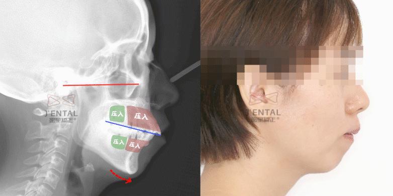 骨性龅牙怎么通过普通的矫正改善,骨钉如何解决骨性龅牙