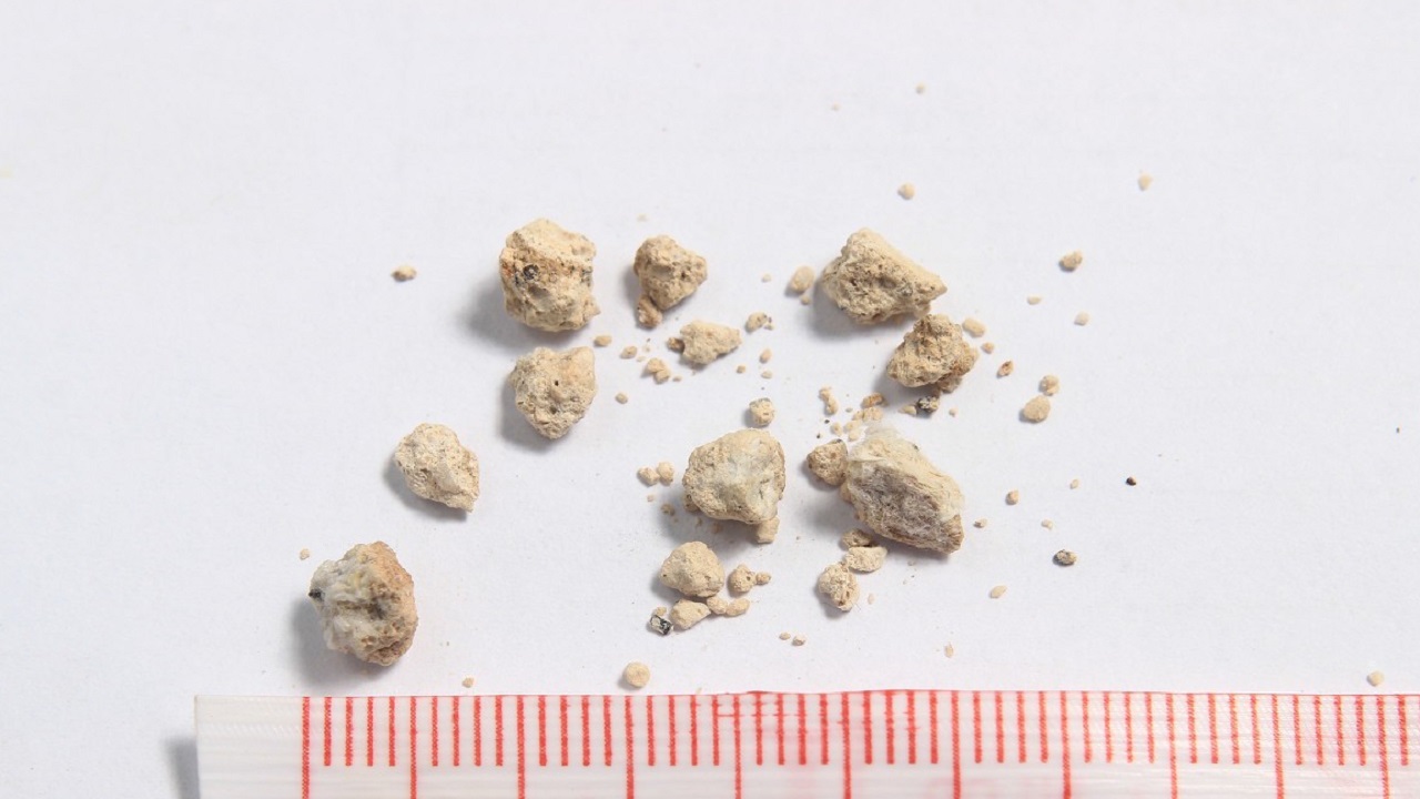 体检查出了肾结石怎么办,体检查出肾结石要不要治疗