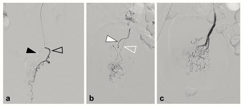 介入科治疗痔疮,介入微创治疗痔疮并出血