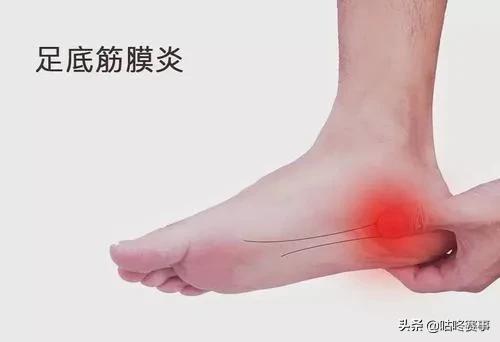 马拉松跑者足底筋膜炎,足底筋膜炎跑步治好