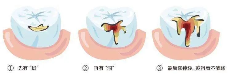 蛀牙到什么程度必须拔掉,蛀牙碰到神经了一定要做根管吗