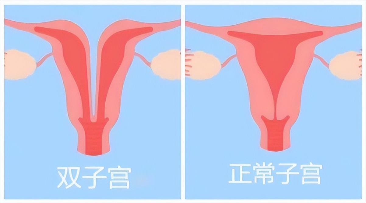 24岁女子体检发现有两个子宫,26岁女子查出双子宫