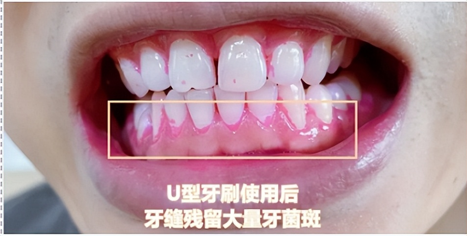 测评飞利浦电动儿童牙刷,儿童电动牙刷推荐5-12岁飞利浦