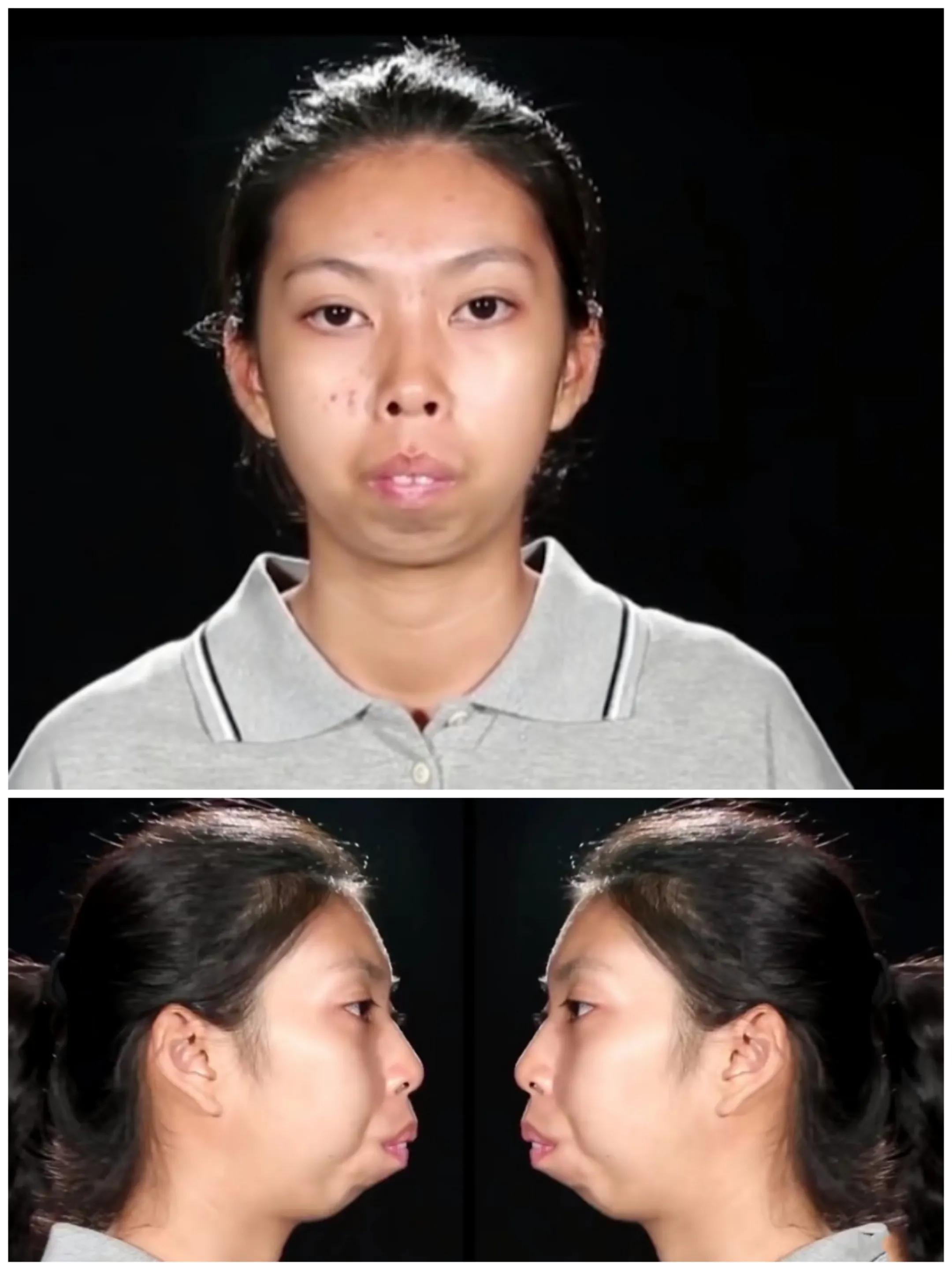 这才是整容存在的意义泰国美女天生没有下巴，整容后迎来全新人生