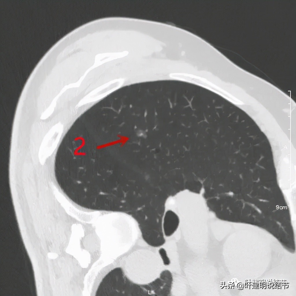 肺多发结节切除一个剩下的怎么办,无限纠结的肺小结节