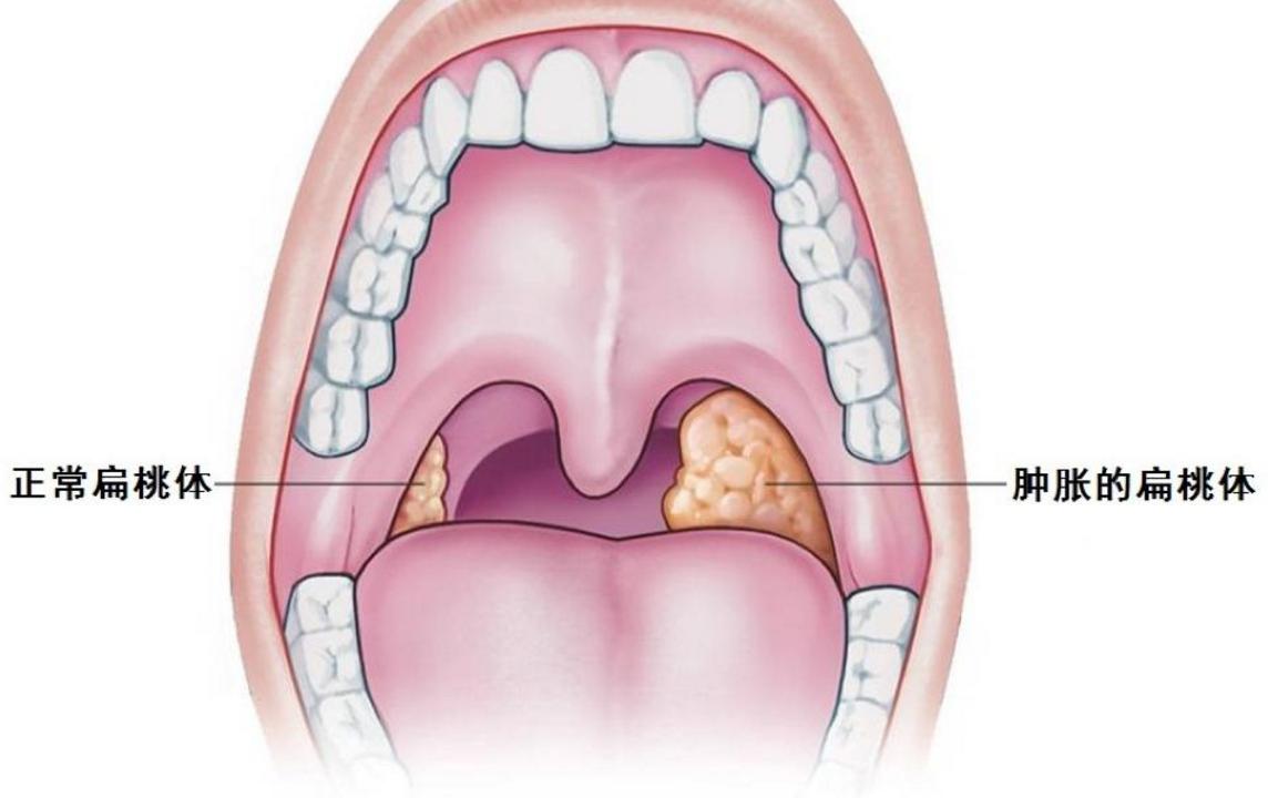脖子突然特别难受怎么处理,脖子疼痛需警惕亚急性甲状腺炎