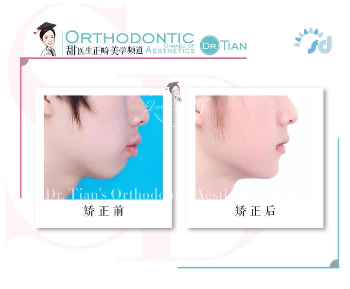 凸嘴下巴后缩拔牙改善有什么坏处,深覆合嘴凸下巴后缩矫正要拔牙吗