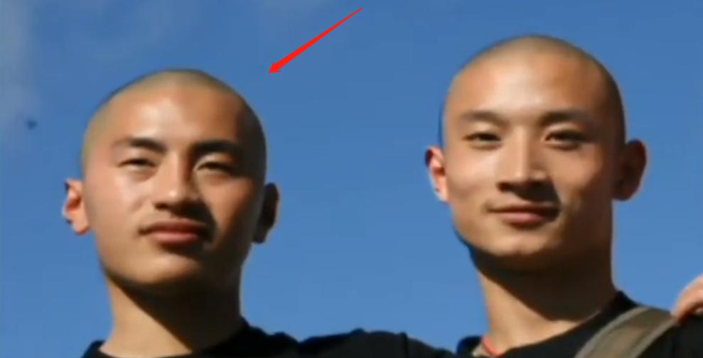 20岁小伙被重度烧伤七年后续,山东男子下肢被烧伤