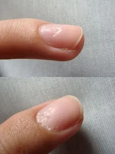 指甲上月牙越多身体越健康吗,指甲上月牙越多代表越健康