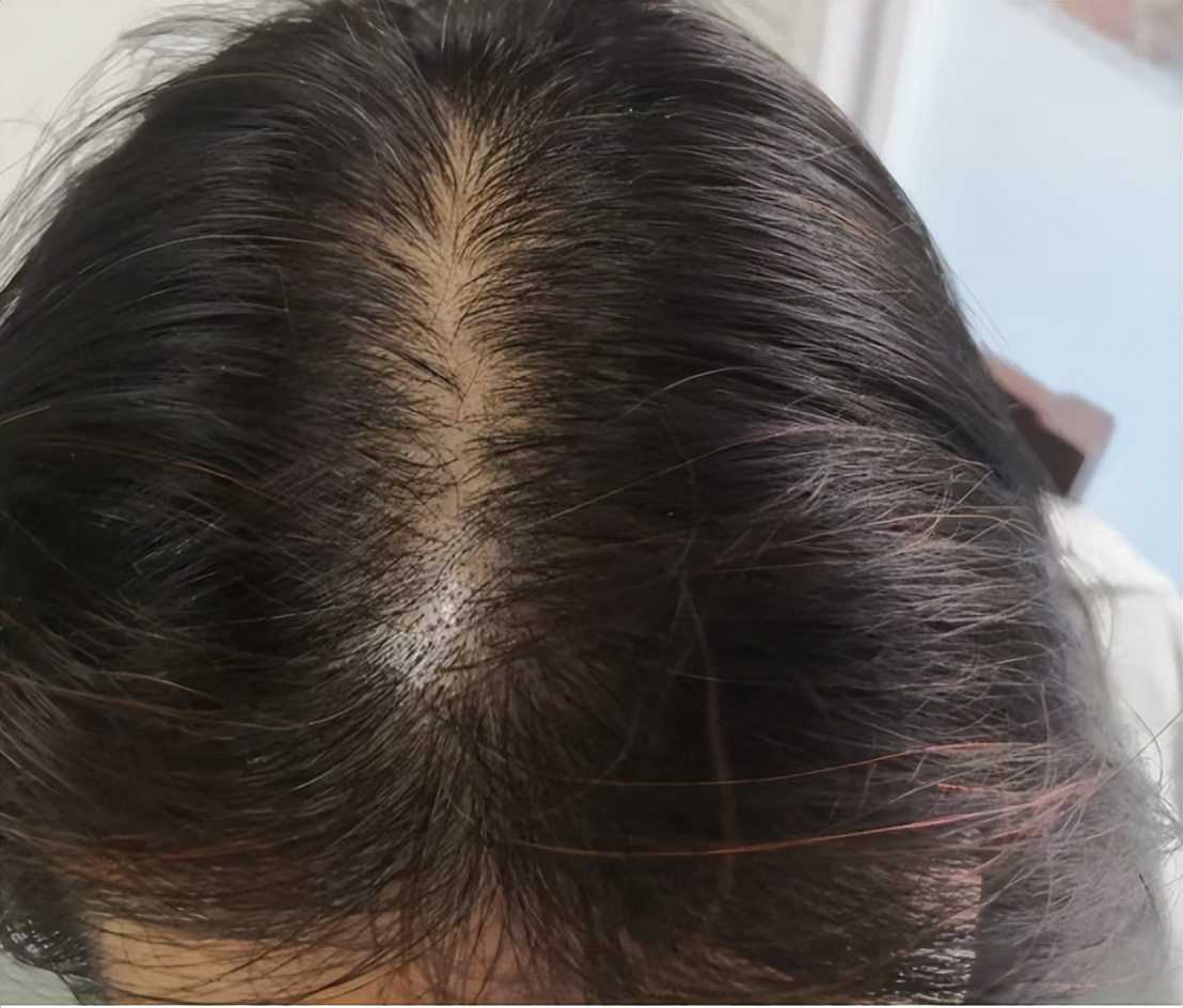 怎样治疗脱发掉头发最有效,掉头发怎么办教你一招永不脱发