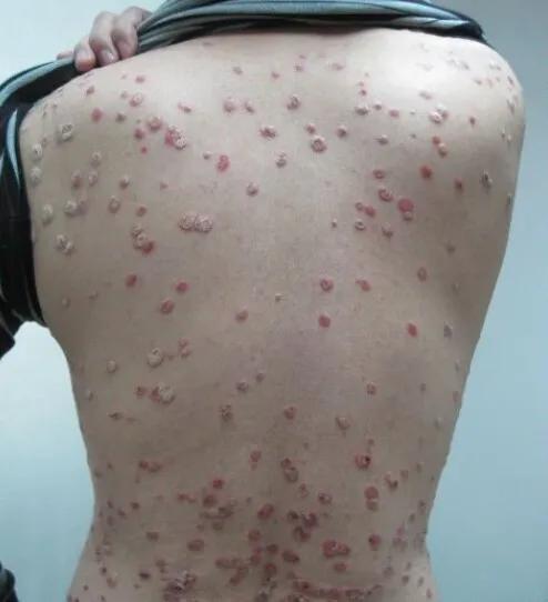 小孩身上抓破皮擦什么好,宝宝皮肤抓破皮有些感染怎么处理