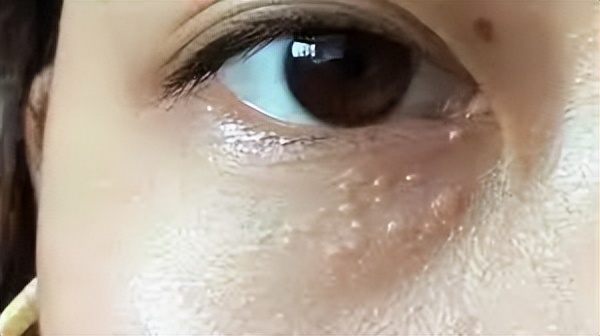 眼周起红色的小疙瘩是怎么回事,眼周起的小疙瘩别忽视