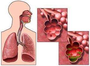 肺气肿如何食疗,中医肺气肿治疗最佳方法
