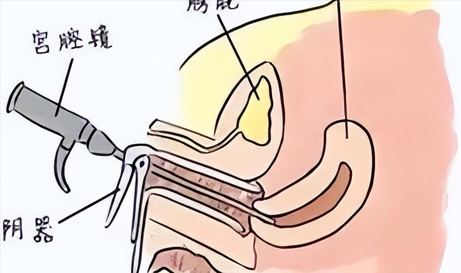 不孕宫腔镜,为什么不孕不育要做宫腔镜