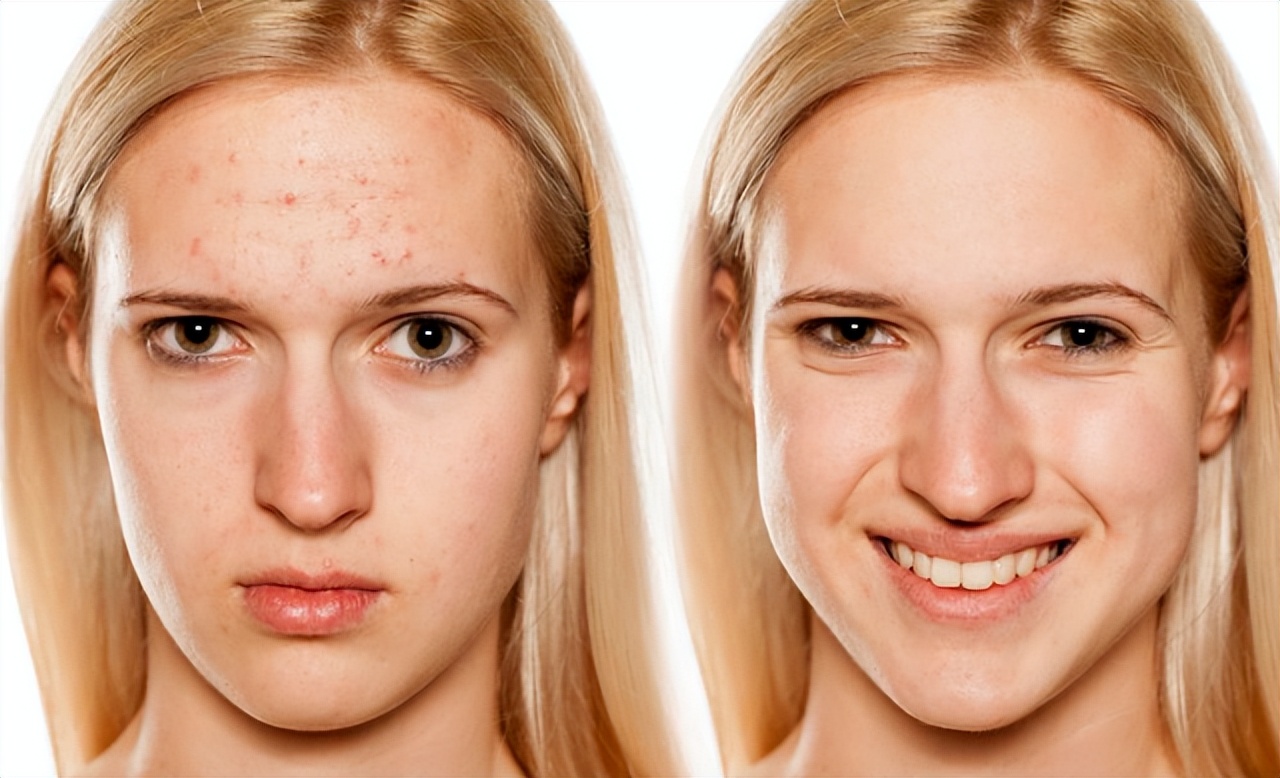 雀斑激光祛斑会反弹吗有副作用吗,激光祛斑会不会都反黑呀