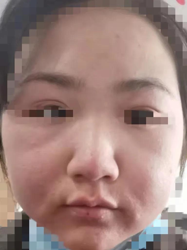 护肤小知识之过敏,过敏期间护肤的正确方法