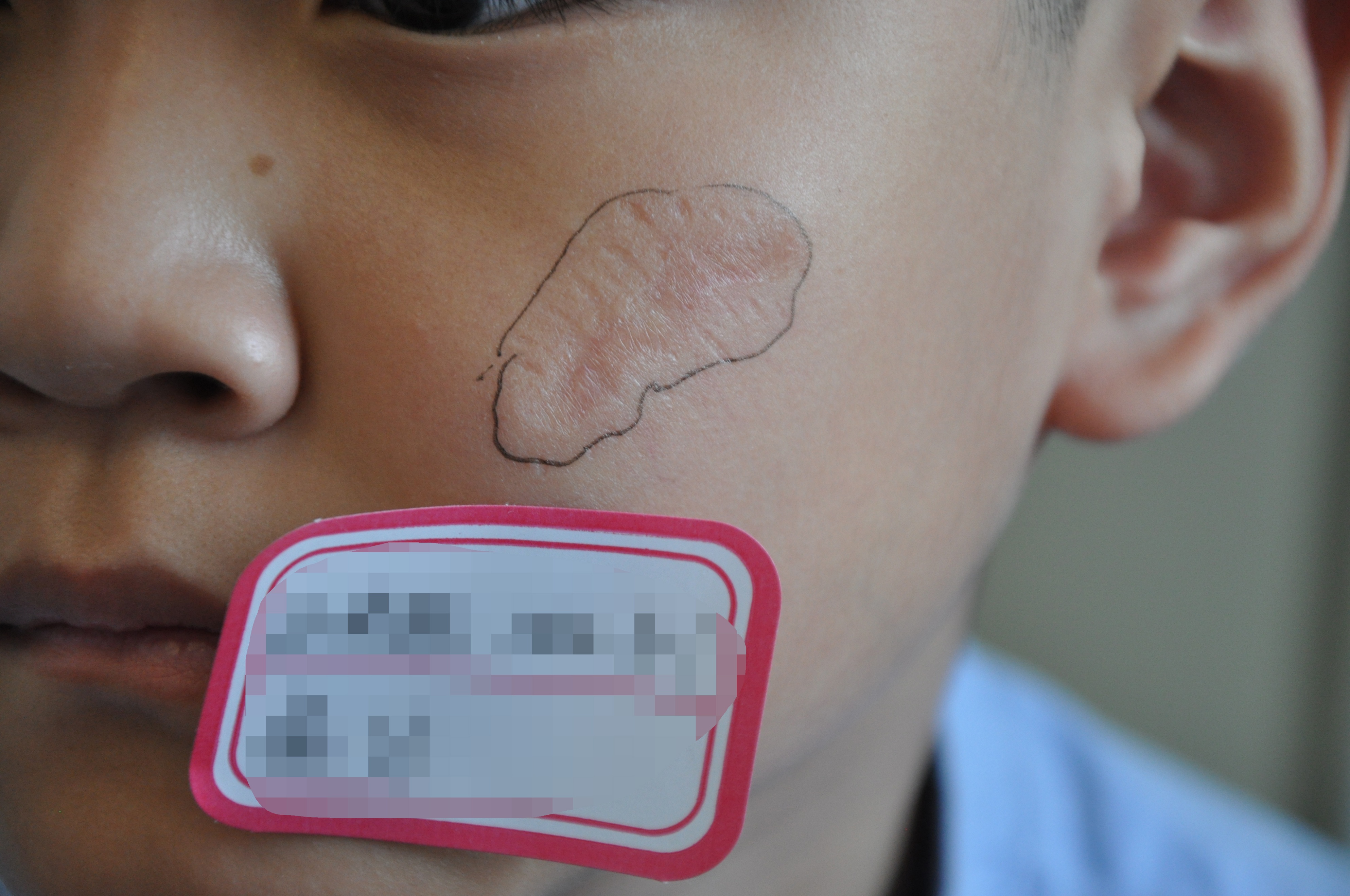 郑州市第二中医院祛疤痕怎样,郑州第二中医院疤痕修复怎么样