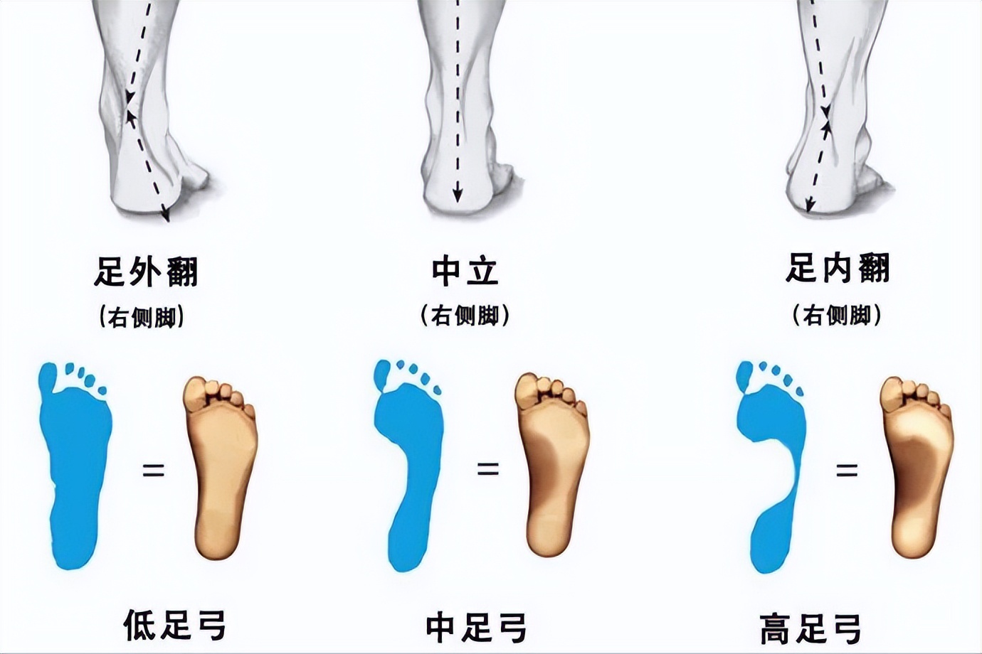 低足弓适合穿什么功能的跑鞋,足弓正常有没有必要穿支撑类跑鞋