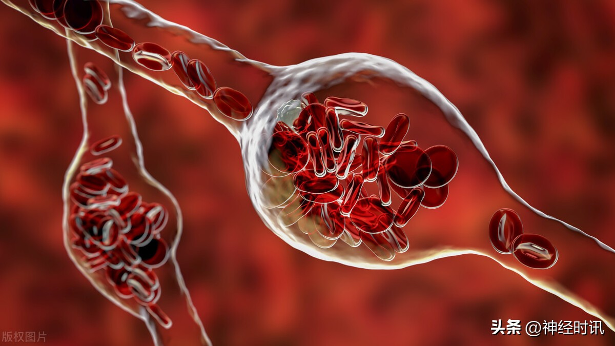 动脉瘤微创和介入治疗有什么区别,动脉瘤介入微创