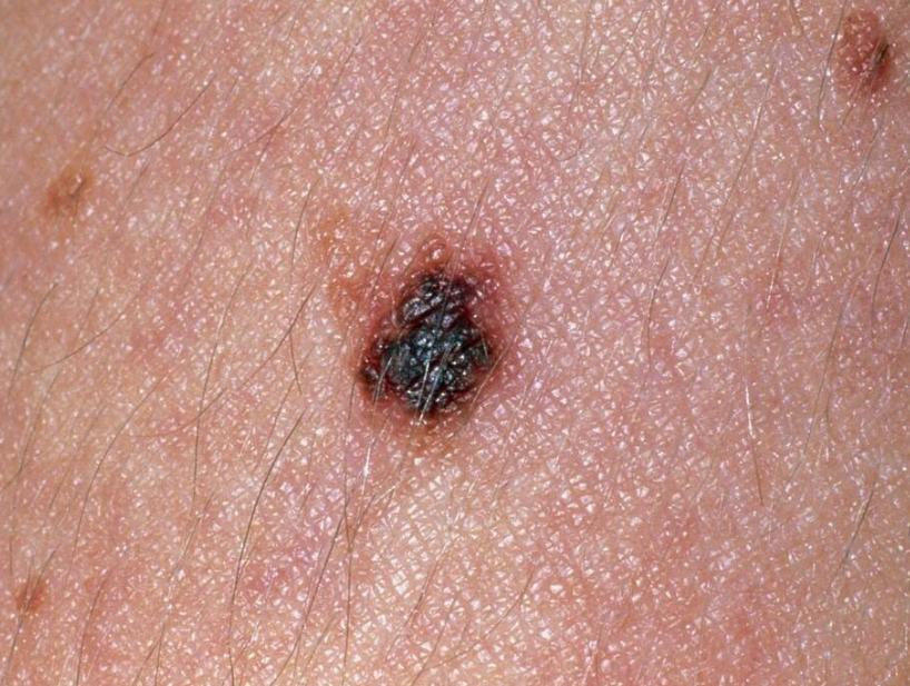 这8个部位长痣或是癌症前兆,痣长在身体这8个部位要小心癌症