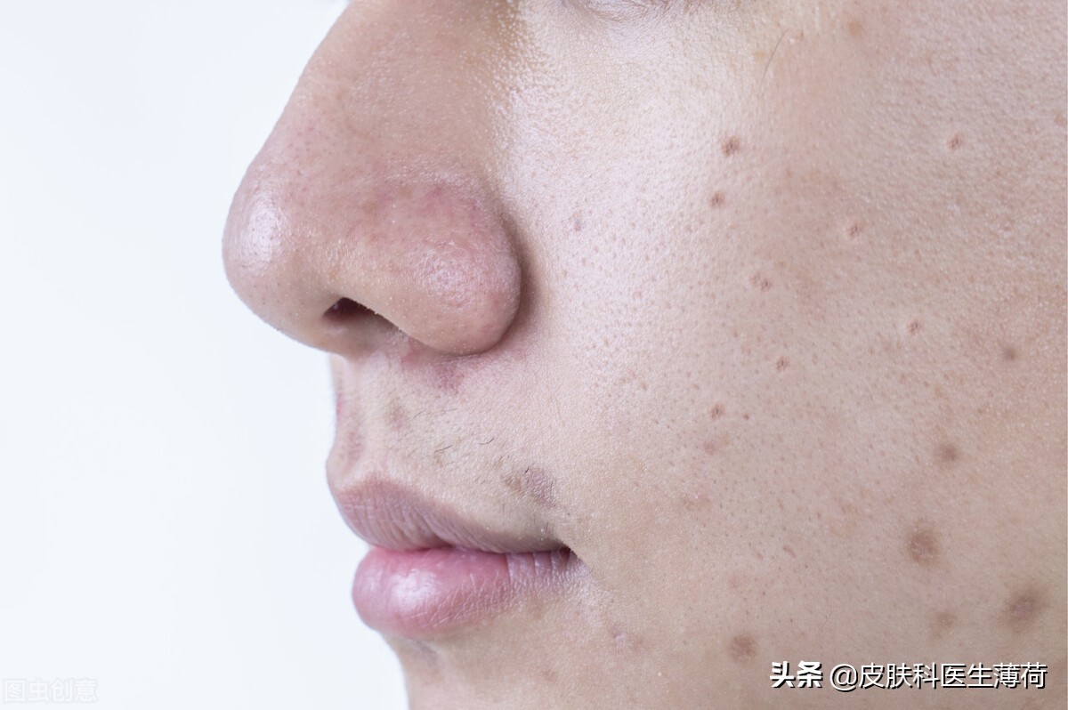 肌漾3.0修印精华淡化痘印,脸上疤痕印怎么消除淡化痘印