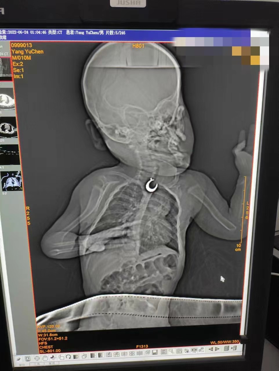 一例无痛小儿食道异物取出术