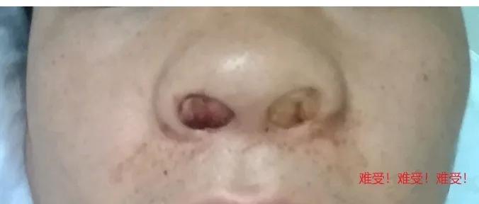 鼻出血介入治疗,鼻出血快速止血