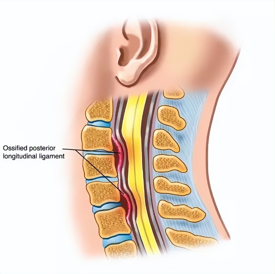 颈椎后韧带骨化是哪种颈椎病,颈椎后纵韧带骨化怎么回事