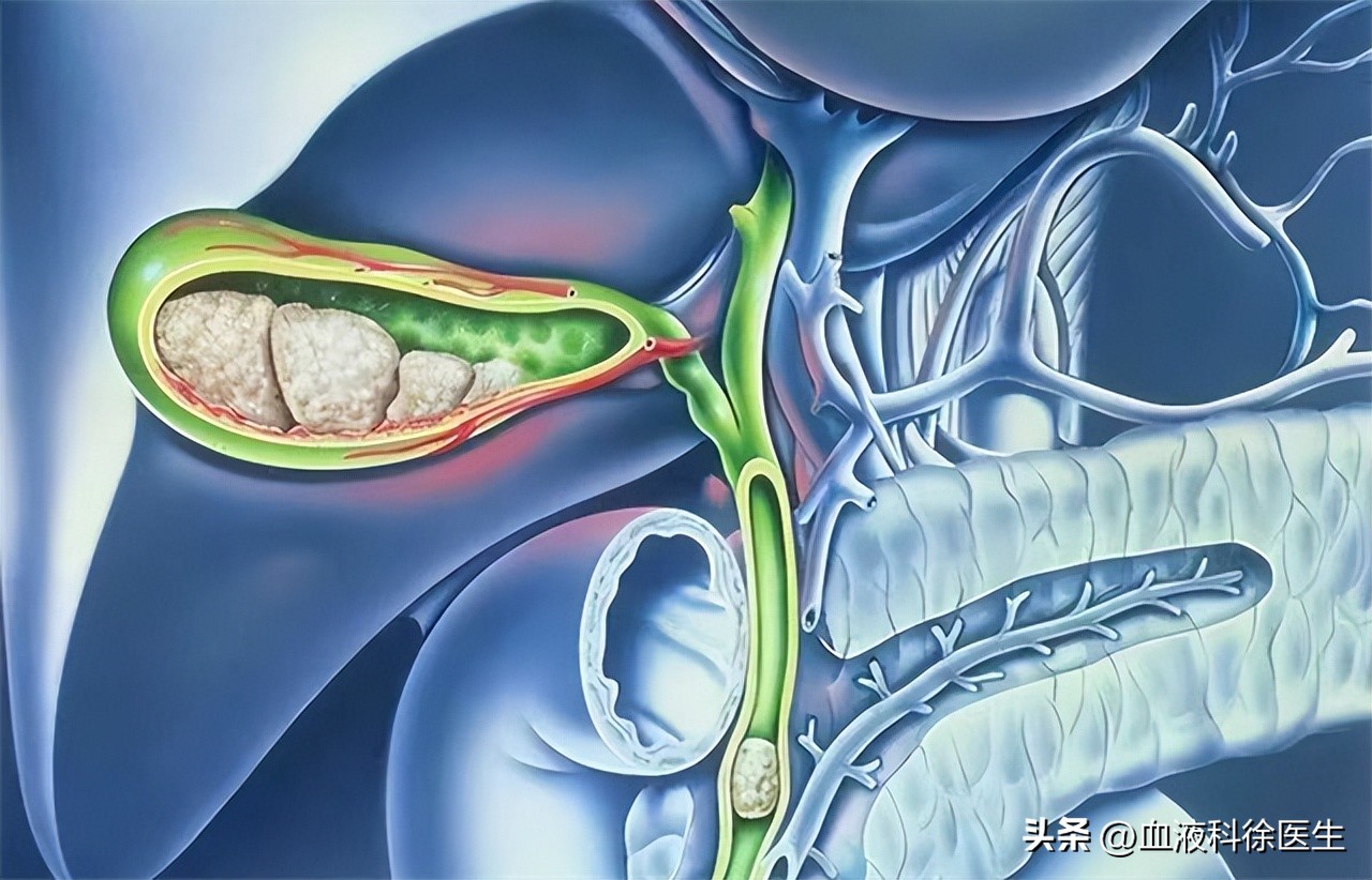 胆囊切除后遗症有哪些,胆囊切除都有哪些后遗症