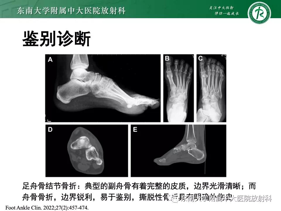 好文分享-《肌骨系统疾病——副舟骨综合征》