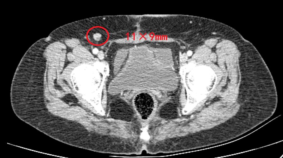 卵巢癌患者BRCA1突变,卵巢癌检测有胚系brca1突变